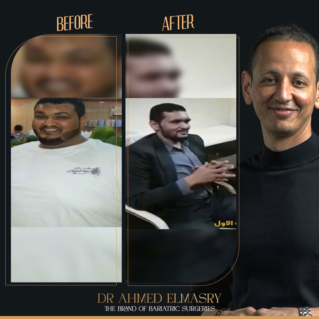 Mazen success story with bariatric surgeries..from Saudi Arabia